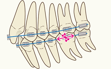 矯正治療 ストレートワイヤー