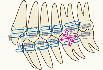 矯正治療 マルチループ