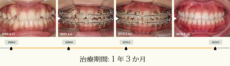 岡亜矢 矯正治療 写真