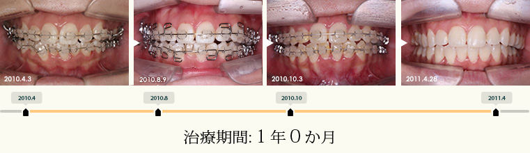 大塚佳那子 矯正治療 写真