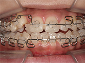 成人矯正 治療例