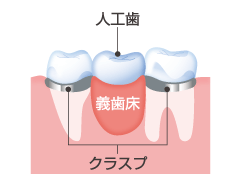 部分入れ歯