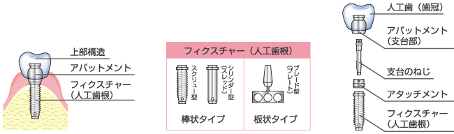 インプラントの構造