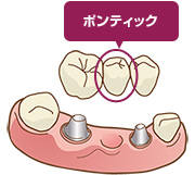 インプラントブリッジポンティック