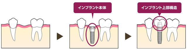 インプラント解説画像／インプラント本体・インプラント上部構造