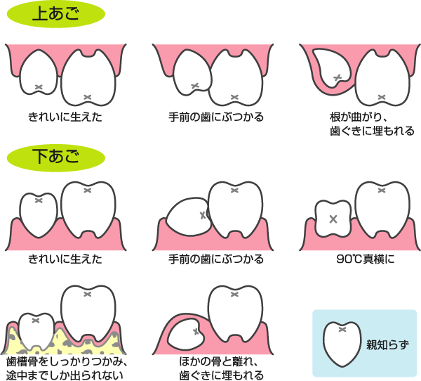 親知らずの生え方いろいろ