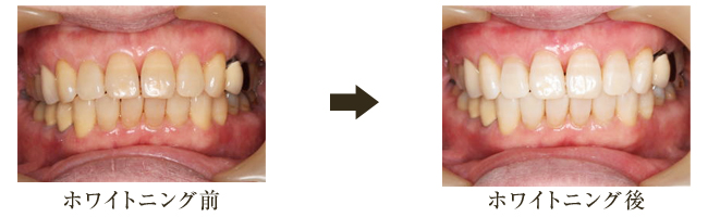 ホワイトニング前とホワイトニング後の違い